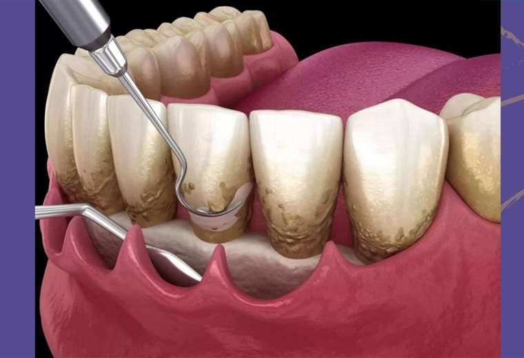 Conozca las posibles soluciones a un diente flojo