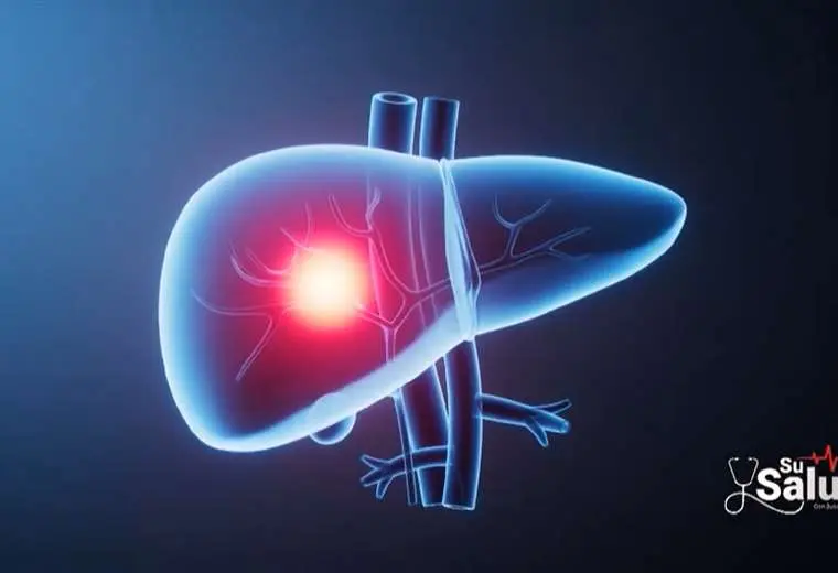 ¿Es cierto que el alcohol daña el hígado? Un médico despeja la duda