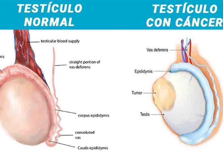 Conozca todo lo que debe saber del cáncer de testículo