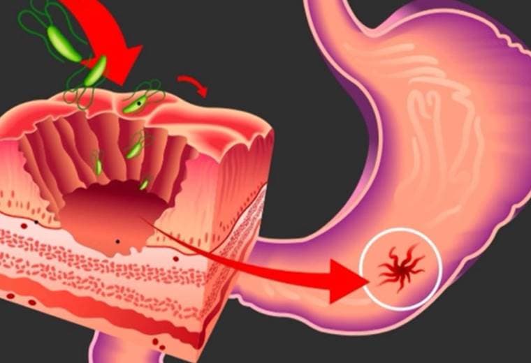 Causas y tratamientos del sangrado digestivo