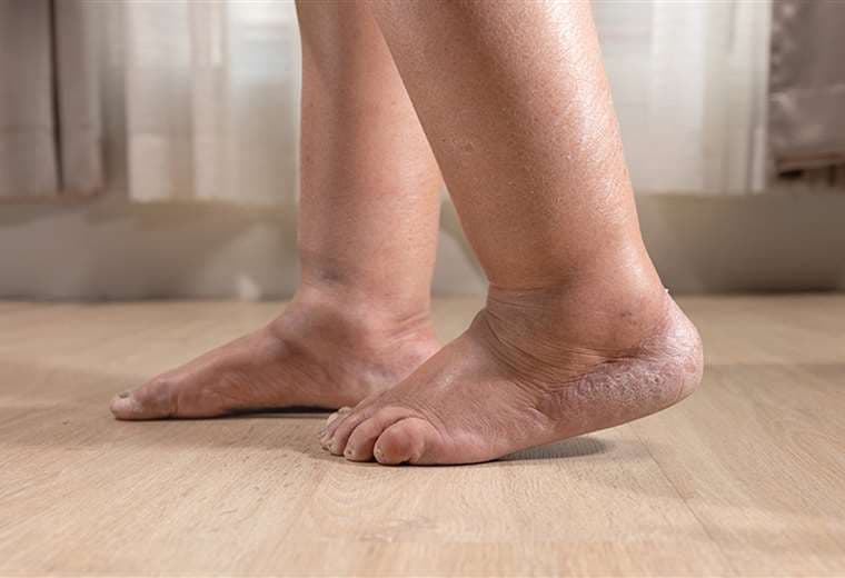 Hinchazón de pies y tobillos puede ser un síntoma de mala circulación