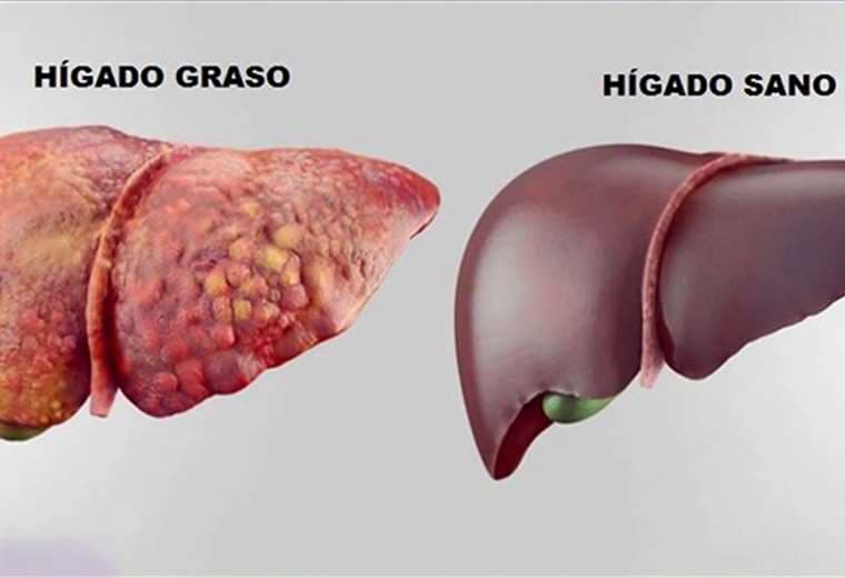 Cinco claves para prevenir el hígado graso