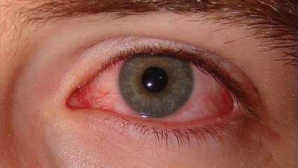 Causas del ojo rojo