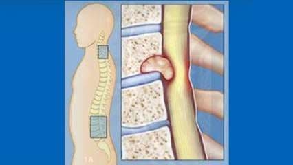 Hablamos sobre tumores benignos y malignos en la columna