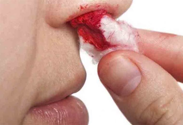 ¿Un sangrado nasal se considera una hemorragia?