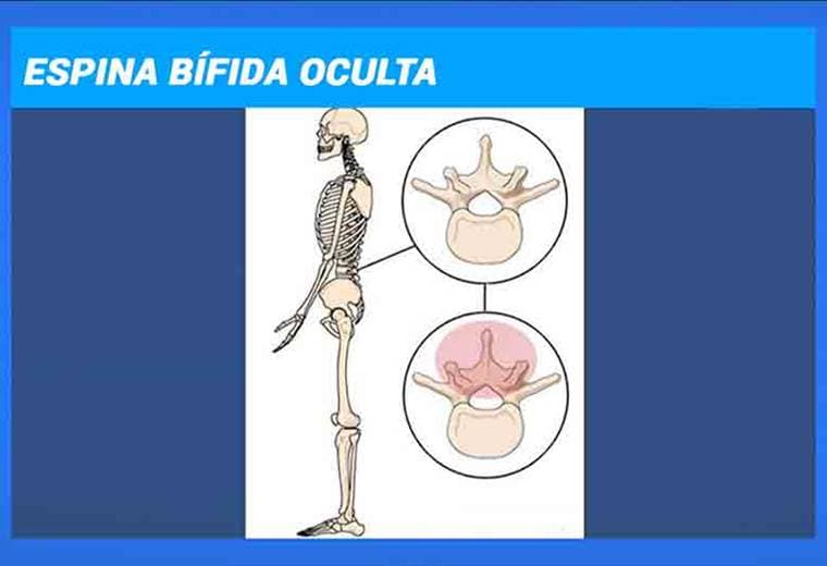 Espina bifida oculta y complicaciones