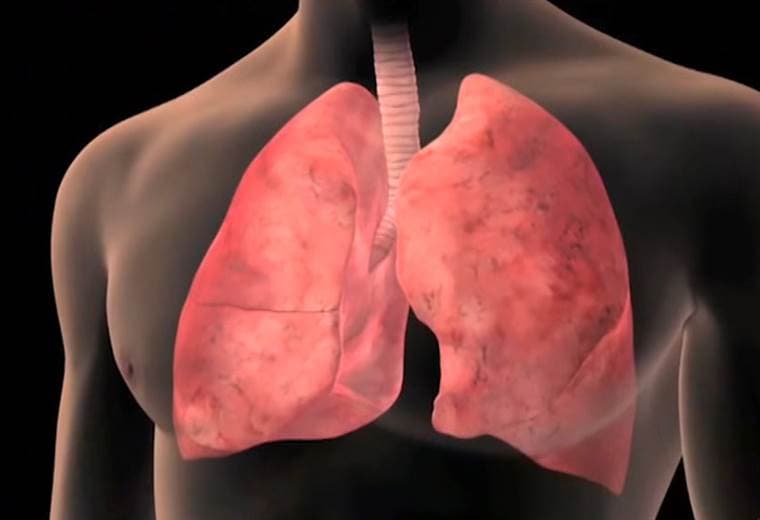 Enfermedad pulmonar obstructiva crónica