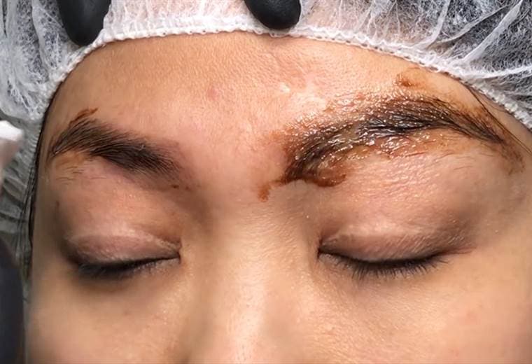 Técnica para remover pigmentación permanente de cejas