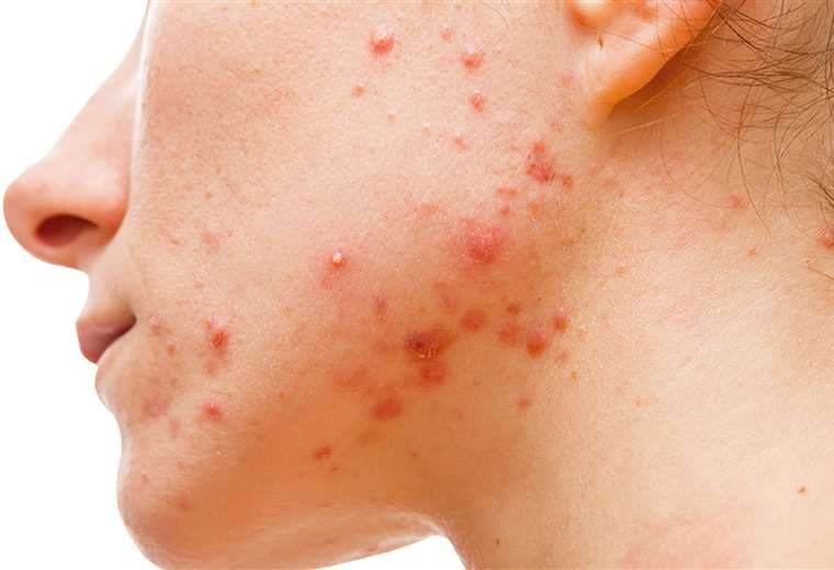 Todo lo que tiene que saber acerca del acné hormonal