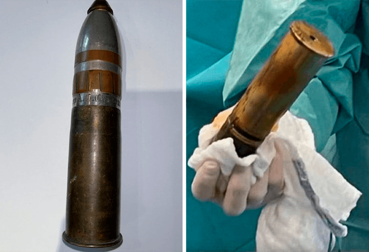 Joven llega al hospital con proyectil de la Primera Guerra Mundial en su recto
